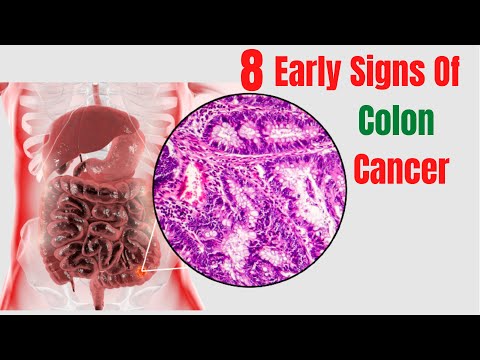 Vroege tekenen van darmkanker | Vroege tekenen en symptomen van darmkanker