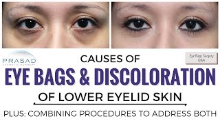 The Causes of Eye Bags and Discolored Lower Eyelid Skin, and Treating Both Separately