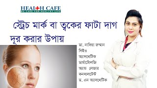 স্ট্রেচ মার্ক  বা ত্বকের  ফাটা দাগ দূর করার উপায়   Health Cafe screenshot 5