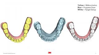 3M™ Clarity™ Aligners Case Study Dr. Hughes