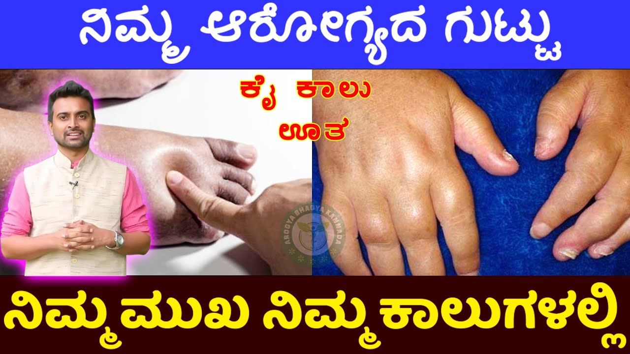 ಕೈಕಾಲು ಊತವನ್ನು ಕಡೆಗಣಿಸಬೇಡಿ । Body Swelling Reasons & Treatment In