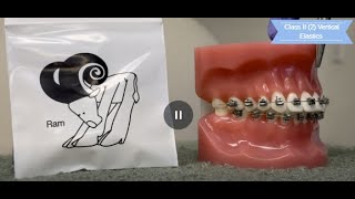 Class II (2) Vertical Elastics