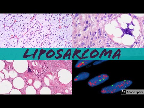 Video: Liposarcoma: Symptomer, Typer, Behandling, Prognose