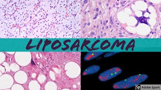 Liposarcoma 101: Everything a Pathologist Needs to Know screenshot 5