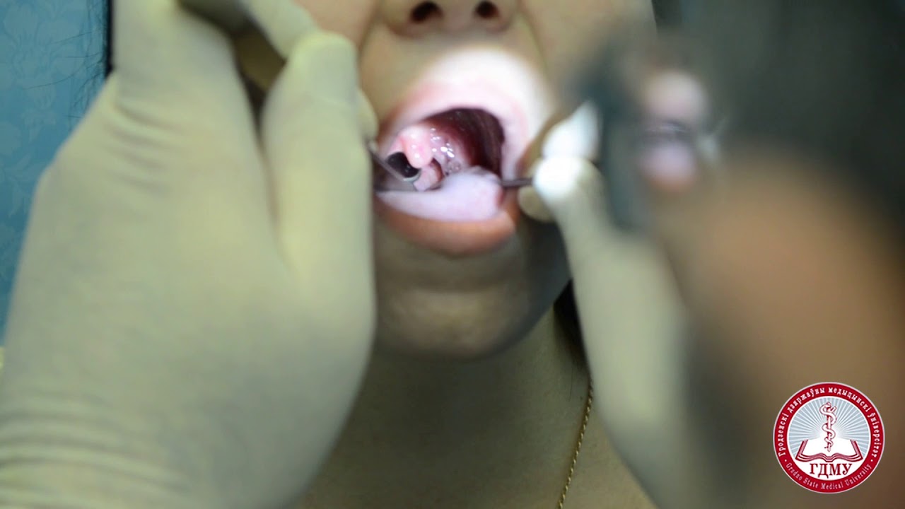 Задняя риноскопия