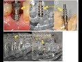 치위생사,치기공사-누구나 쉽게~임프코핑(impcoping)과 디지털 스캔바디(scanbody) 이해편_각각 설명,장단점 및 활용법//기존 아날로그방식vs트렌드 디지털인상