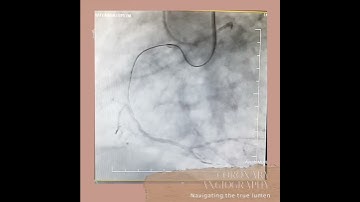 RCA CTO angioplasty