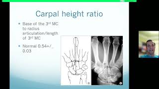 Perilunate Fractures - Dr. Dancea - 04/17/2023