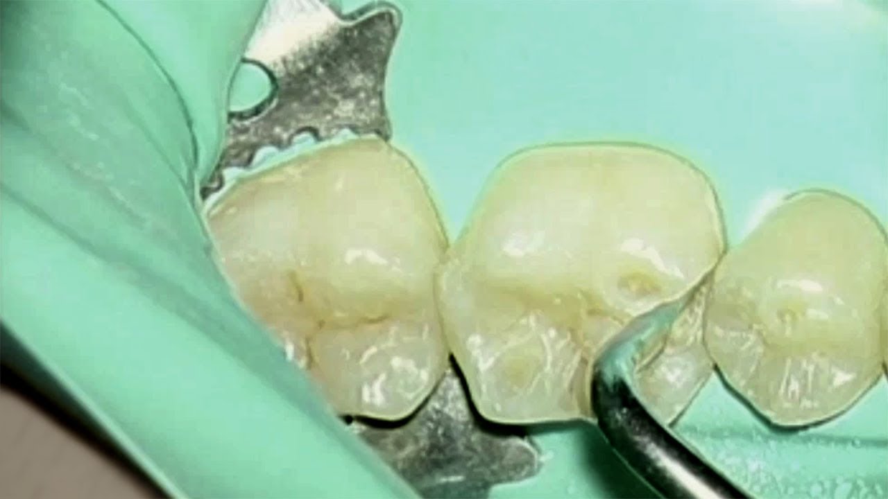 Kavitätenpräparation/Cavity preparation, Dr. Agabiti Italien, Komet SonicLine
