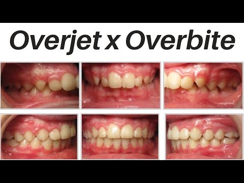 Vídeo: Overjet: Causas, Tratamento Versus Overbite E Muito Mais