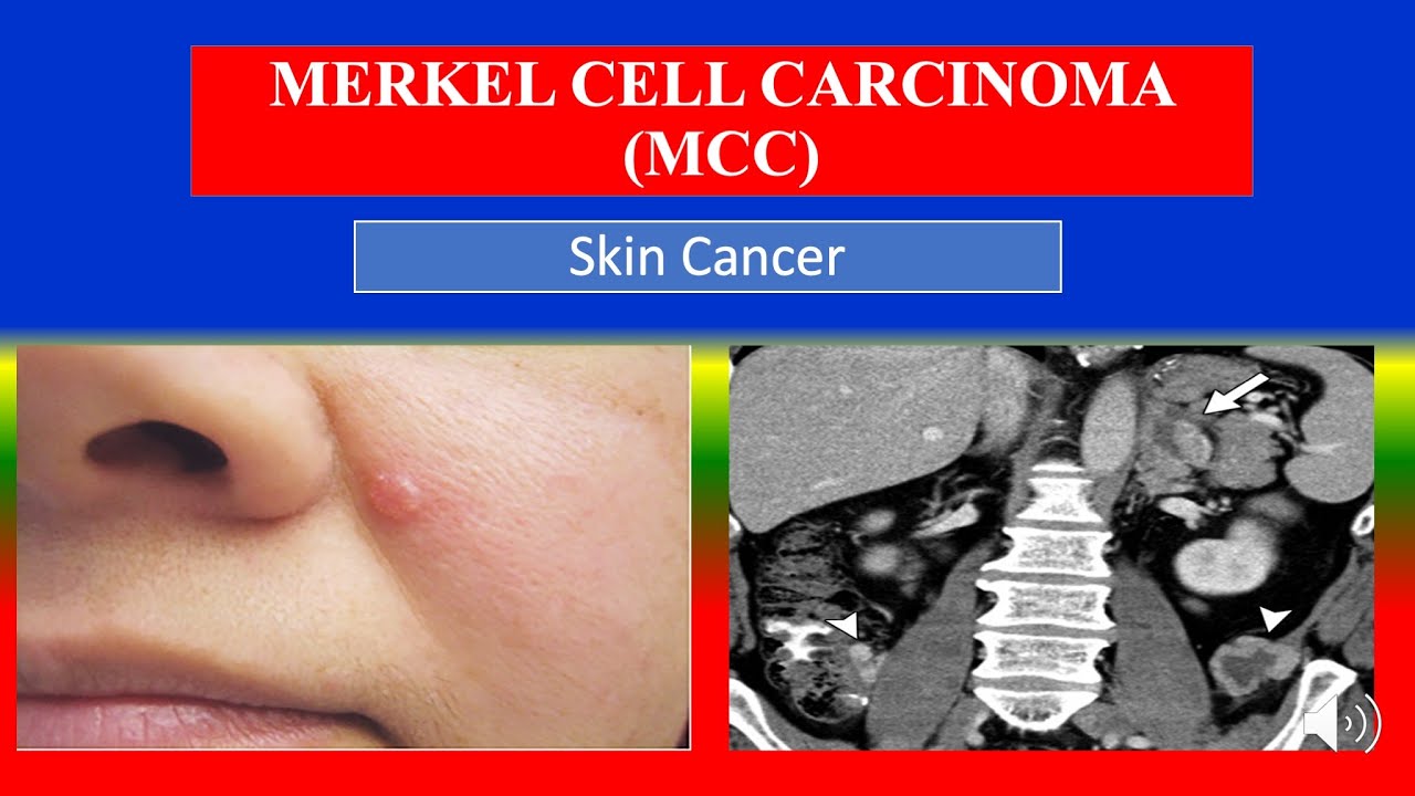 MERKEL CELL CARCINOMA (MCC) - Definition, types, causes ...