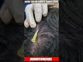 Mono Threads for Androgenic Alopecia &amp; Hair Loss at Aastha Skin &amp; Dermato-Cosmetic Centre