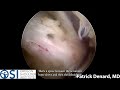 Shoulder Arthroscopy after Reverse Shoulder Replacement