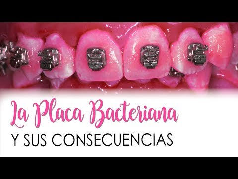 Vídeo: Placa Dental: Qué Es, Qué La Causa Y Cómo Deshacerse De I