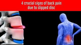 Back pain dua to slipped disc, 4 crucial signs and symptoms