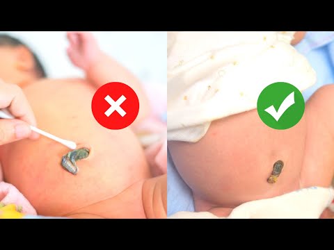 EASY Newborn Umbilical Cord Care