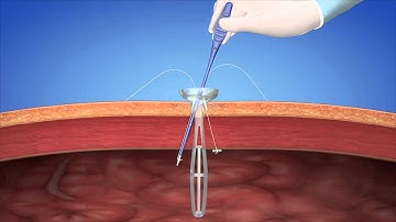 neoClose®  product animation