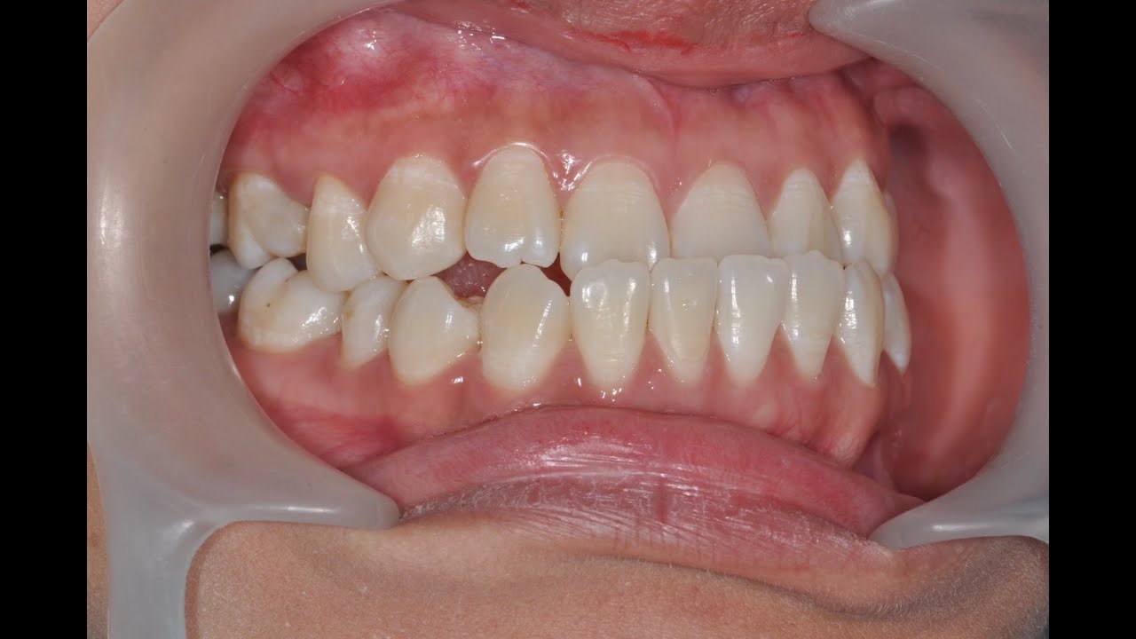 Class III Malocclusion - YouTube