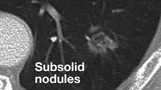 Subsolid Nodules