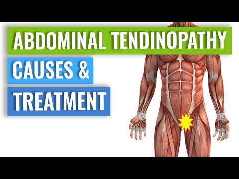 Abdominal Tendinopathy - Causes & Treatment, Including Exercises