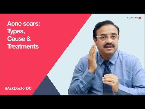 Acne scars: Types,Cause & Treatments (English)