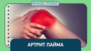 #НАЗДОРОВЬЕ: артрит Лайма