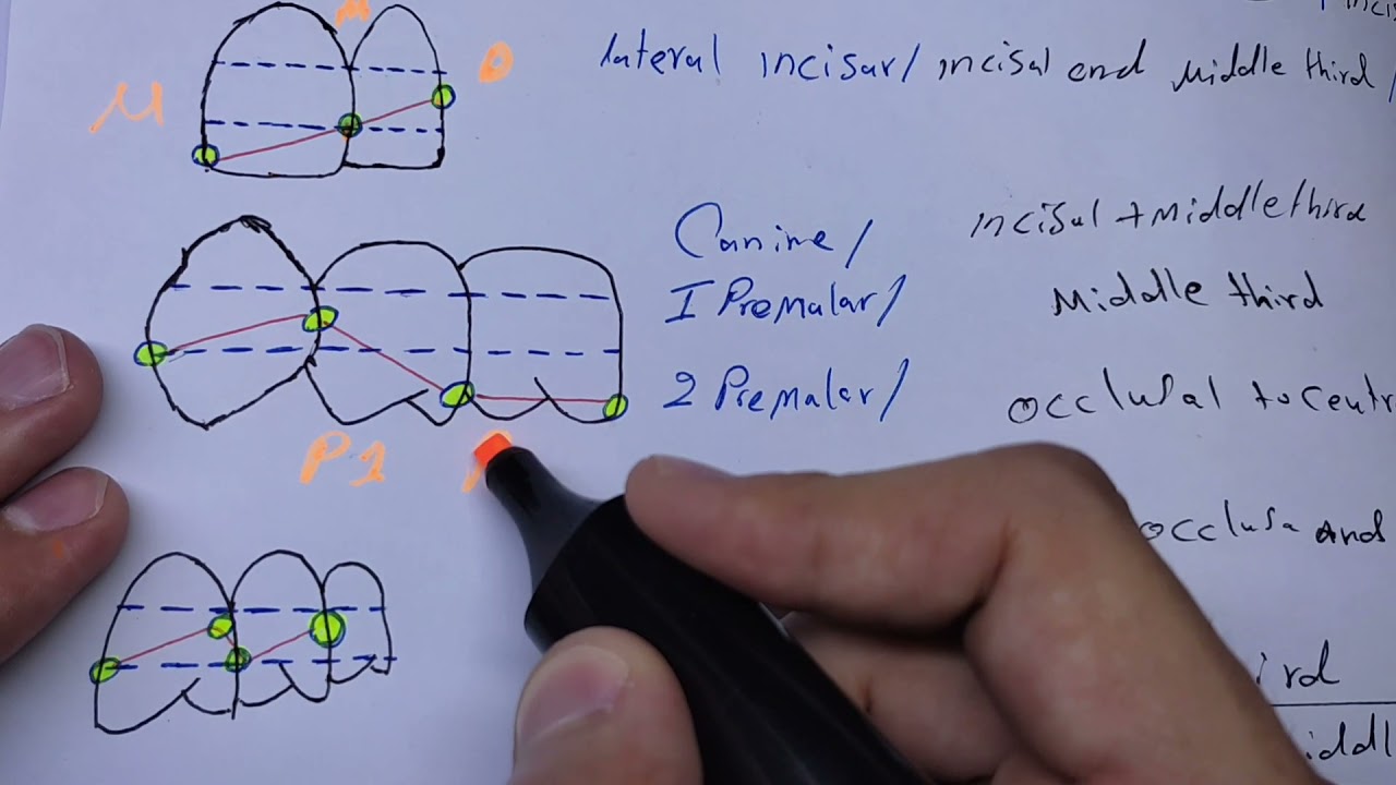 contact area//crest of cuvitur//maxillary teeth