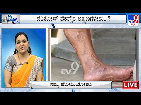 Nimma Doctor | Treatment For Varicose Veins | Namma Homeopathy (11-08-2023)