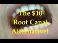 The $10 root canal alternative!