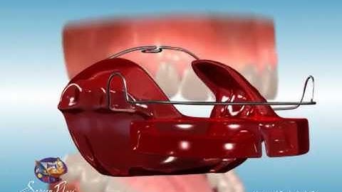 ScreenPlay Orthodontic Education Videos: Bionator Appliance