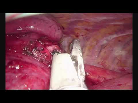 Asvide: Postero-lateral bi-segmentectomy (S9-10) of the left lower lobe by UVATS approach