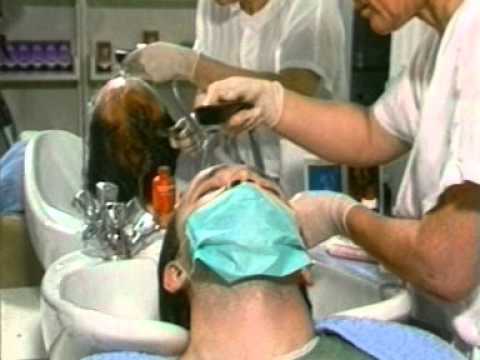 Biofibre Hair Implant Biofibre.mpg - YouTube