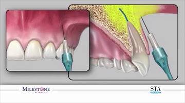 The Wand® STA Instrument - Supraperiosteal Buccal Infiltration