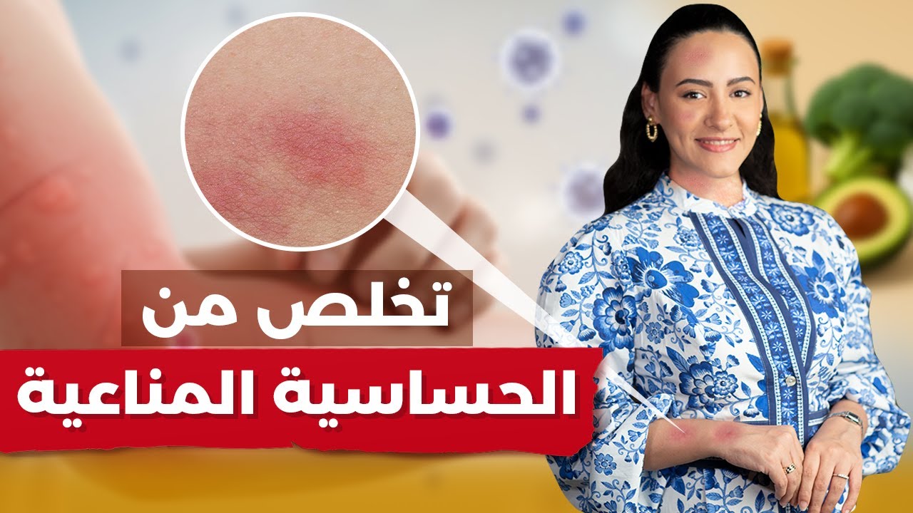 الأسباب الخفية وراء الحساسية المناعية.. ومضادات الهيستامين ليست الحل!