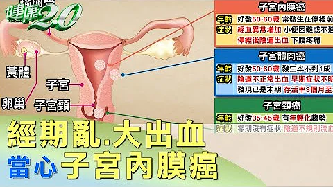 经期乱、大出血 当心子宫内膜癌 健康2.0 - 天天要闻
