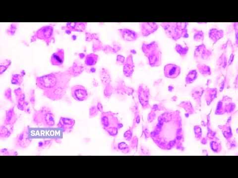 Video: Rakovinové Metastázy V Páteři (obratle)