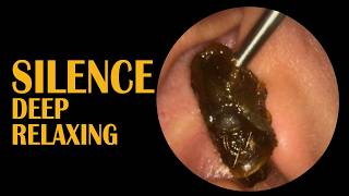 Silent White Cholesteatoma Cleaning 👂😮 | Deep Ear Cleaning ASMR