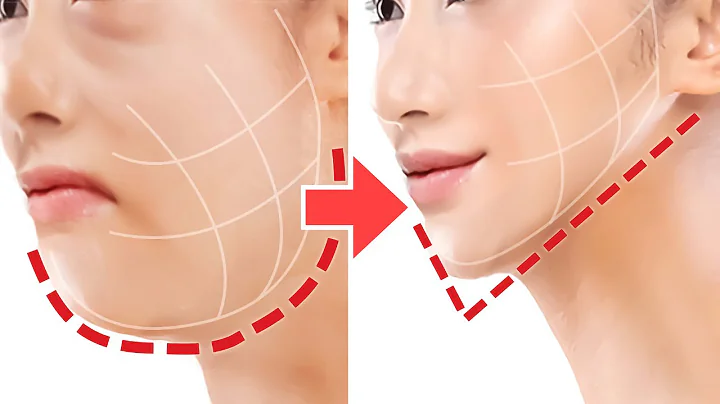 Face Lifting Exercise For JAWLINE, V-Shaped, Sagging Jowls, Cheeks! Look 10Years Younger, Anti-Aging