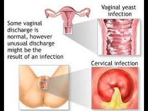 Crystal X Nasa : Cara menghilangkan Keputihan Dalam hitungan Hari Crystal X Nasa : Cara menghilangkan Keputihan Dalam hitungan Hari