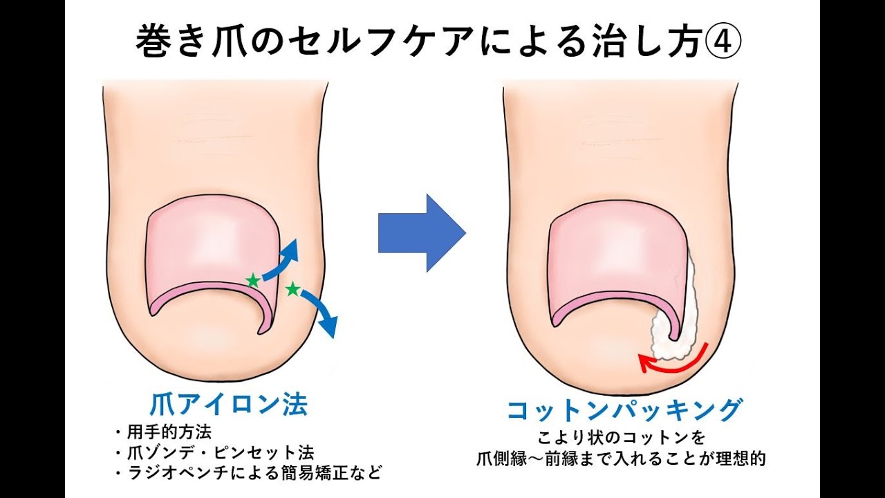 巻き爪の治し方 自分でコットンで治す方法は 大木皮膚科 Youtube