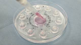 The usage of the toROMAN™ microfluidic sperm sorting chip - (Part of sample collection)