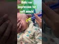 Baby Ear Impression For Soft Mould Congenital Hearing Loss