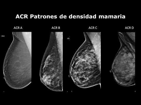 Vídeo: Evaluación De La Inhomogeneidad De La Dosis Objetivo En El Tratamiento Del Cáncer De Mama Debido A Diferencias Elementales En Los Tejidos