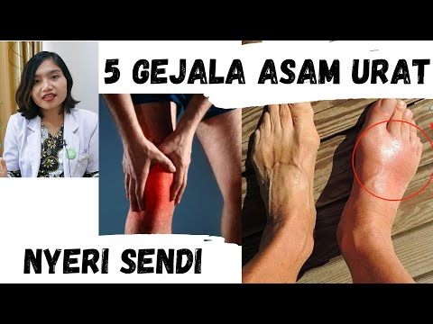 Video: Gout Pada Wanita Dan Pria: Ada Apa, Gejala, Foto Di Kaki
