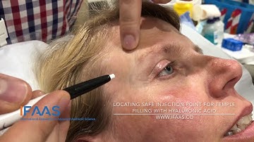 Locating Safe Injection Point For Temple Filling with Hyaluronic Acid