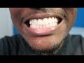 Crest 3D Whitestrips • 3 Months Later Review/Tips! (Whiten Your Teeth)