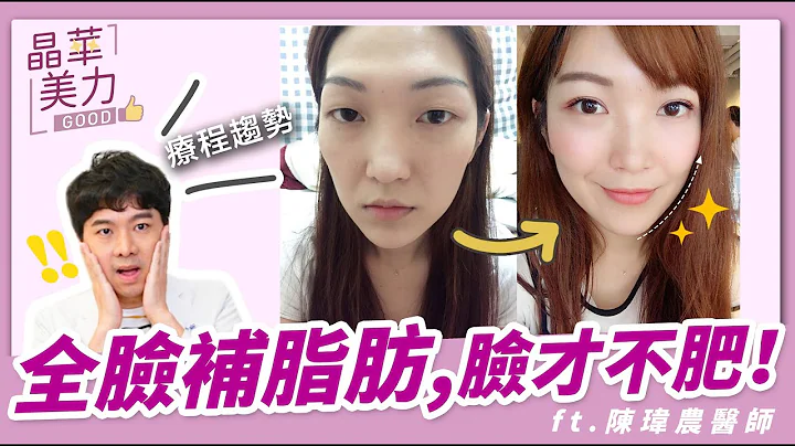 自體脂肪補臉｜玻尿酸填補和全臉補脂差在哪？臉部填充如何選？額頭、夫妻宮、蘋果肌凹陷等【晶華醫美診所】陳瑋農醫師｜晶華美力GOOD｜桃園自體脂肪補臉推薦 桃園自體脂肪補脂診所推薦 自體脂肪移植醫師 - 天天要聞