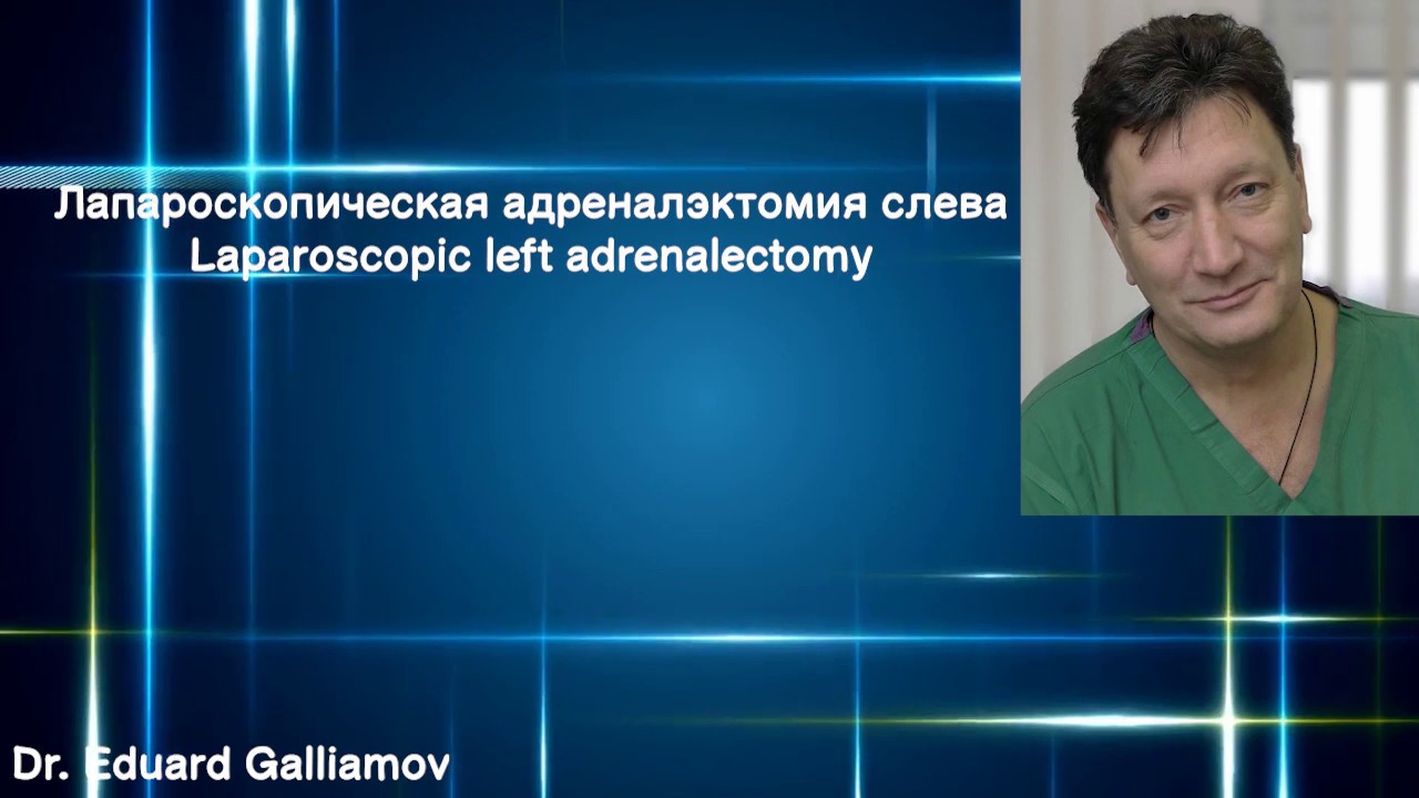 Лапароскопическая адреналэктомия слева / Laparoscopic left ...