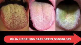 Dilimizin üzərindəki sarı ərpin səbəbləri Resimi