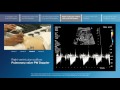 Part 4 - Right ventricular outflow color and PW Doppler